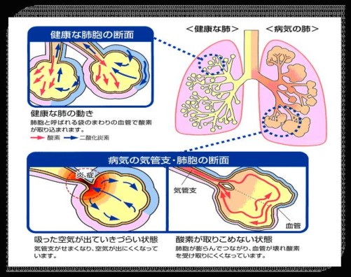 肺気腫 慢性 【COPD:肺気腫】看護過程・看護目標・看護展開と病態生理まとめ