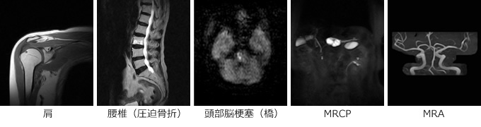 MRI画像(肩・腰椎・頭部脳梗塞・MRCP・MRA)